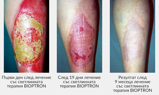 Zepter-Bioptron-wounds